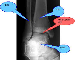 <p>• Medial malleolus</p><p>• Lateral malleolus</p><p>• Talus between them.</p>
