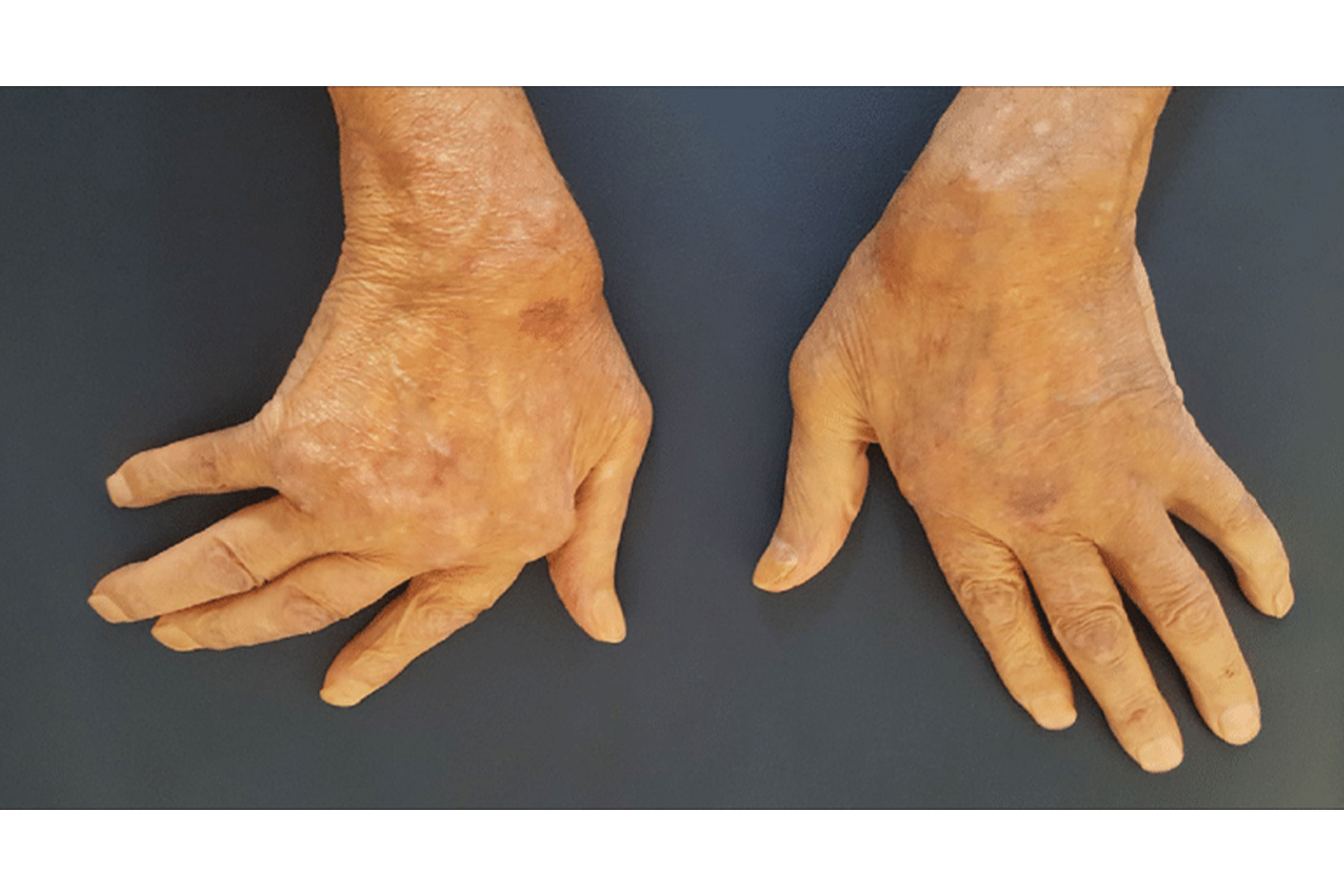 <p>Ulnar deviation of the fingers.</p>
