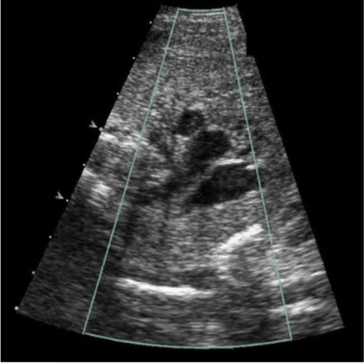 <p>Locate the superior vena cava on the three vessel view</p>
