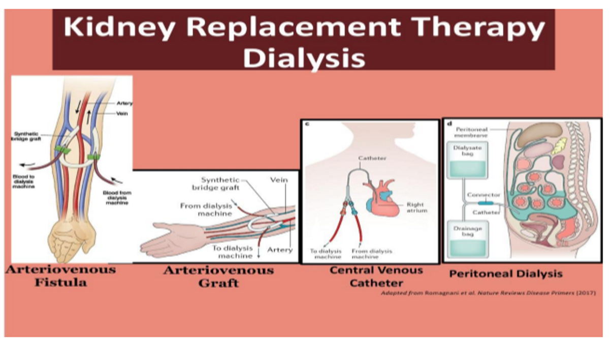 <p>Peritoneal dialysis</p>