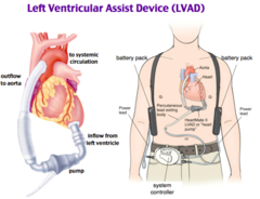 <p>Manually pumps the ventricle while waiting for heart transplant</p>