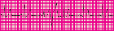 <p>Which rhythm is this?</p>