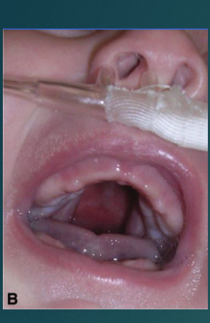 <p><span style="color: rgb(248, 71, 71);">Failure </span>of the palatal shelves <span style="color: rgb(253, 151, 151);">(secondary palate) to fuse</span>.</p>