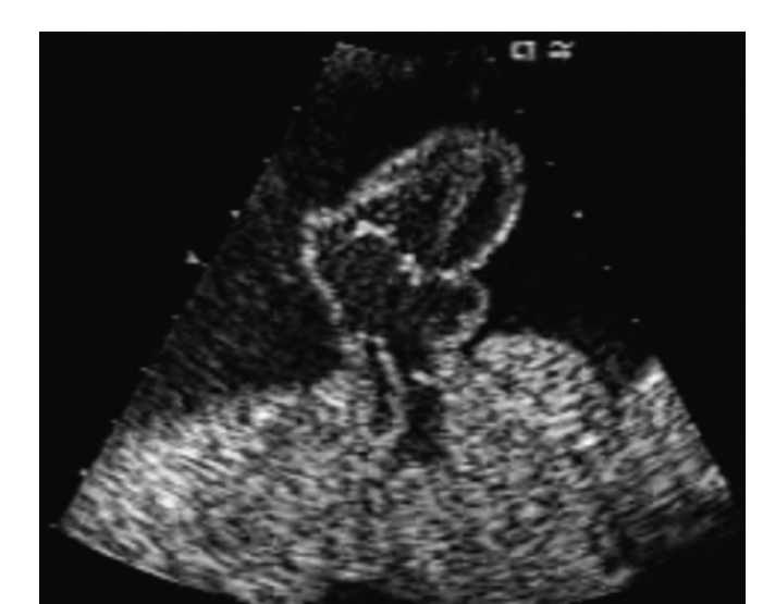 <p>The heart is located outside of the chest cavity </p><p>• 2/3rds are male • </p><p>Associated with trisomy 18</p>