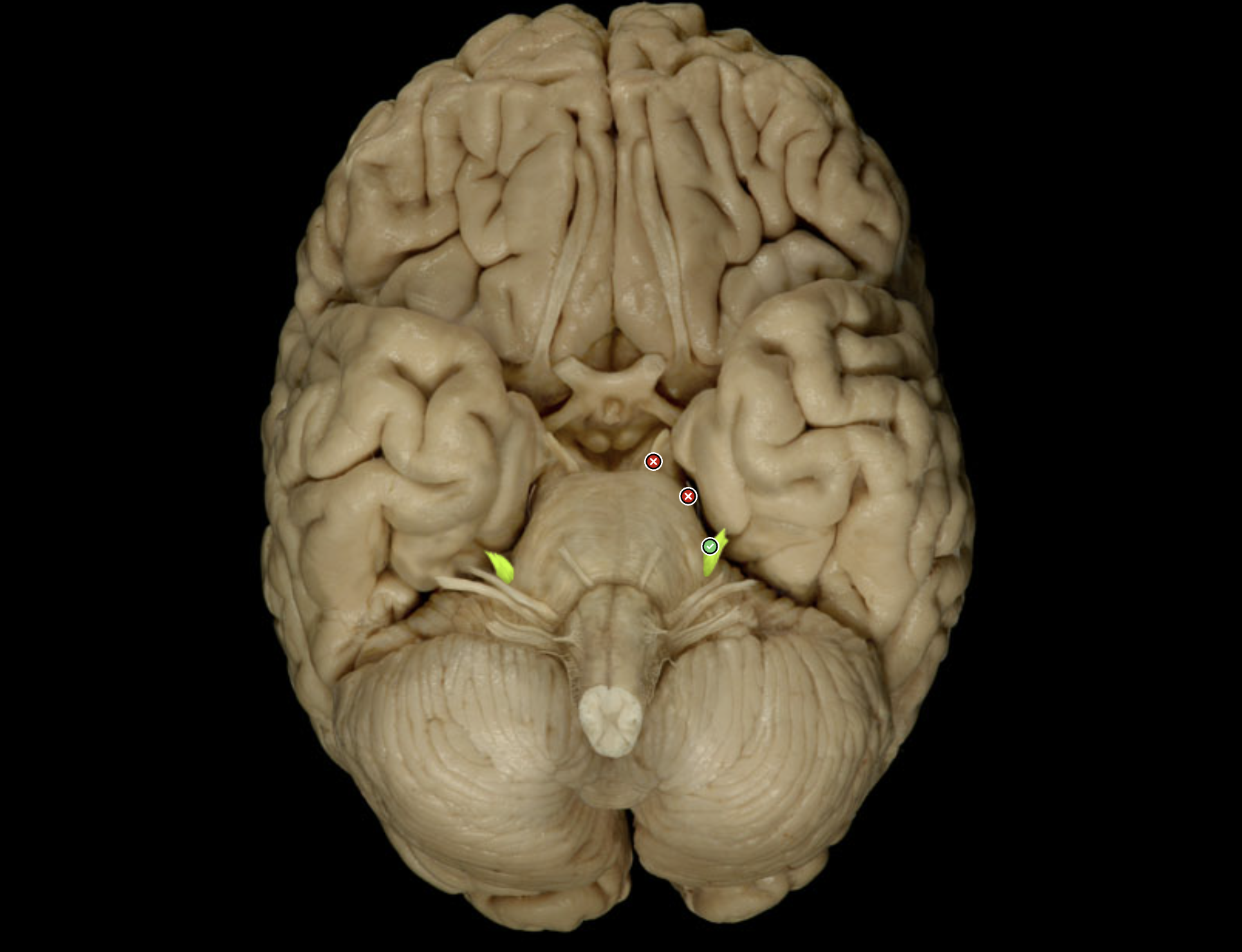 <p>Which nerve is labeled?</p>