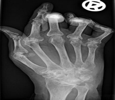 <p>What is the pathology shown?</p>