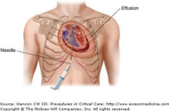<p>- Needle drainage of the pericardial sac</p><p>- Use 16-18g long needle to drain sac</p><p>- Place drainage tube until patient can be transferred to definitive care</p>