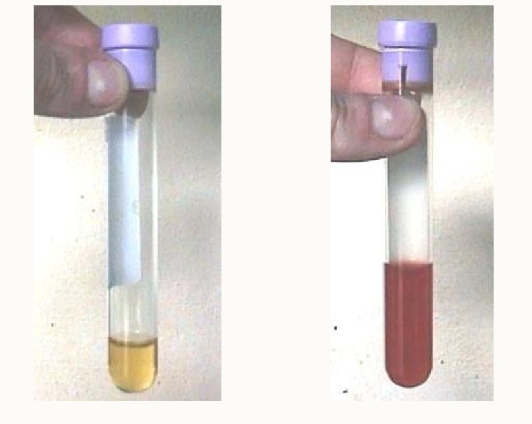 <p>Which peritoneal tap sample is normal vs abnormal?</p>