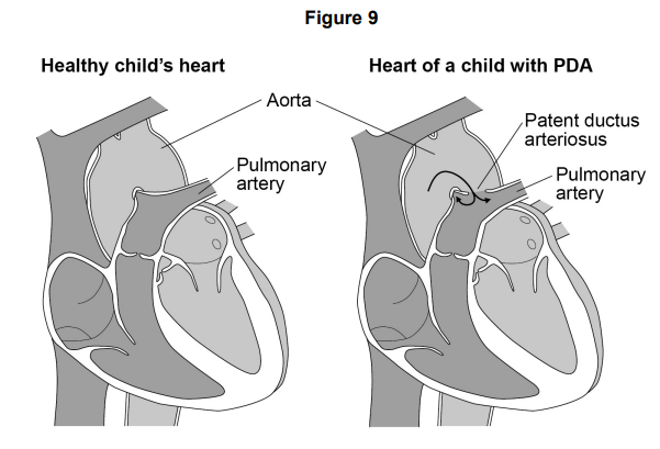 <p>Most children born with Patau syndrome die in the first 12 months, often due to defects of circulation of blood.</p><p>One of these defects is patent ductus arteriosus (PDA). This can result in some of the blood flowing between the aorta and the pulmonary artery.</p><p><strong>Figure 9</strong> shows a healthy child’s heart and the heart of a child with PDA.</p><p>Suggest how the flow of some of the blood between the aorta and pulmonary artery could cause children to die in the first 12 months. (3) </p>