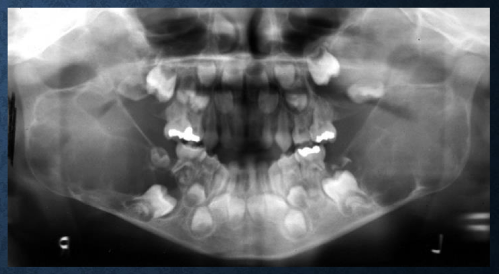 <p>a lesion that anteriorly displaces teeth is typically…</p>