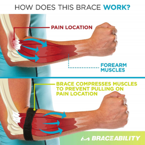 <p>Treatment for Lateral Epicondylitis (tennis elbow)<br>-what does bracing do </p>