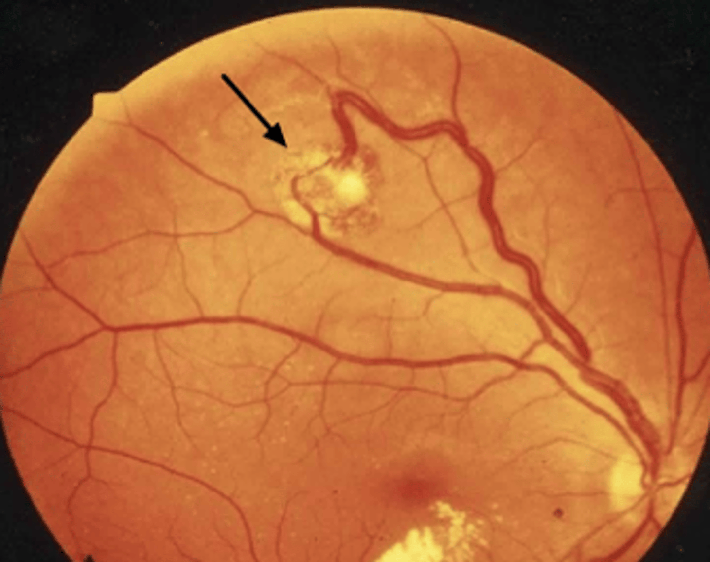 <p>CNS hemangioblastomas: HA, ataxia, focal neuro deficits</p><p>Retinal hemangioblastomas: vision loss</p><p>Renal cell carcinoma</p>