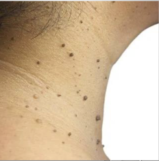 <p>benign growths</p><p>cause: unknown</p><p>symptoms: small, skin colored, soft, pedunculated papules; can become irritated in friction areas; common on neck, axillae and upper trunk</p><p>treatment: none necessary; surgical removal when needed, snipping without anesthesia </p>