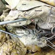 <p>the more inferior branch of the Y</p><p>supplies the greater curvature of the stomach</p><ul><li><p>structure</p></li></ul><p></p>