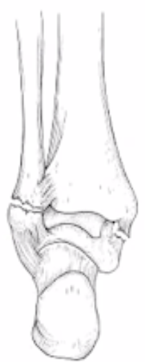 <p>What fracture is this?</p>