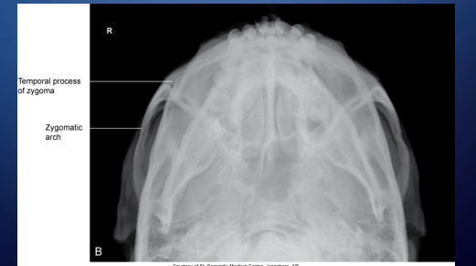 <p>SMV ZYGOMATIC ARCHES</p>