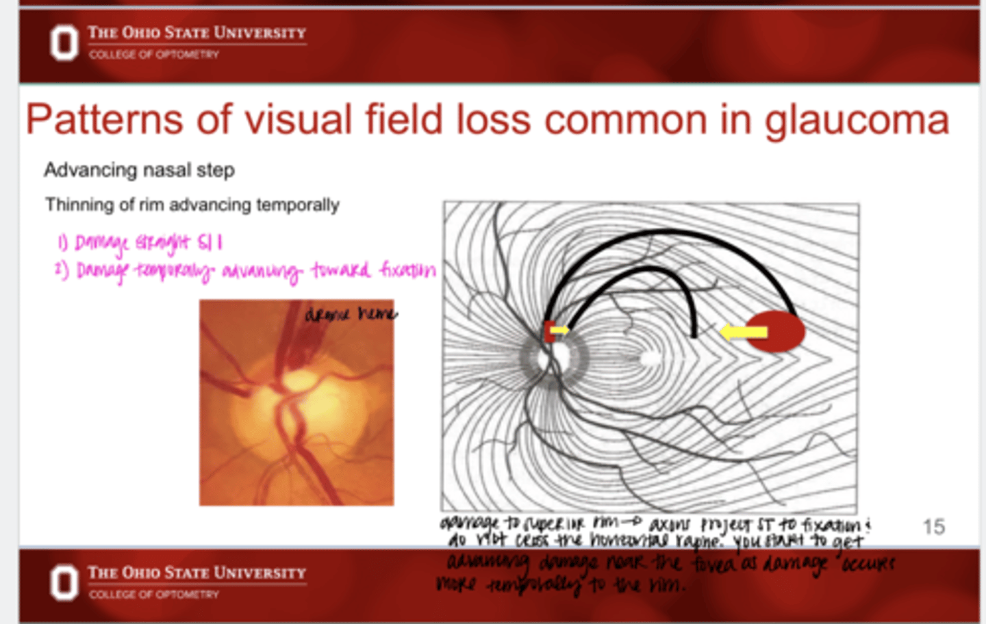 <p>What is the characteristic appearance of an advancing nasal step VF defect?</p>