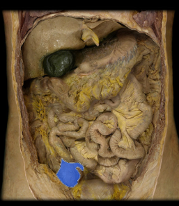 <p>connects to ileum, vermiform appendix attaches to this, lower right side of the abdominal cavity as, short wide pouch</p>