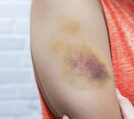 <p>A localized collection of blood under the skin or in tissue from a damaged blood vessel (usually a closed injury).</p><ul><li><p>ABCs, assess MOI</p></li><li><p><strong>Consider internal injury/shock</strong> if large or high-risk location</p></li><li><p>Cold pack (not directly on skin)</p></li><li><p>Splint if associated with extremity injury</p></li><li><p>Monitor</p></li></ul><p></p>