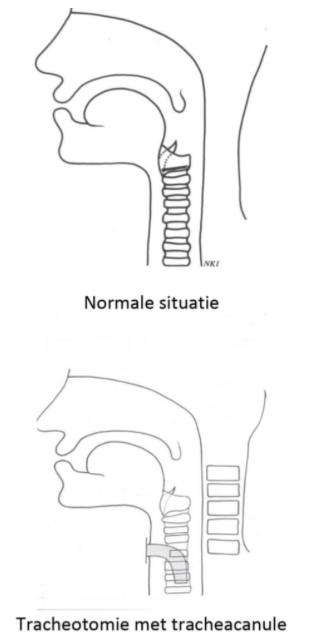 <ul><li><p>snee in luchtpijn → opening gemaakt (niet een snelle behandeling omdat je allemaal structuren tegenkomt</p></li><li><p>electieve tracheotomie = klassieke methode → tijd om te opereren</p></li><li><p>percutane dilatatie tracheotomie (PDT) = versnelde methode</p></li><li><p>laatste redmiddel is coniotomie</p></li><li><p>verticale incisie, door huid,vet en schildklier naar trachea</p></li></ul><p></p><p></p>