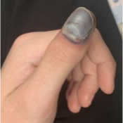 <ul><li><p>Huge blood collection under nail plate and causes pressure → can kill the plate if left untreated </p></li><li><p>Trephination </p><ul><li><p>Hot coil and burn hole into plate and erupts </p></li><li><p>Immediate pain relief and evacuates the hematoma </p></li></ul></li></ul><p></p>