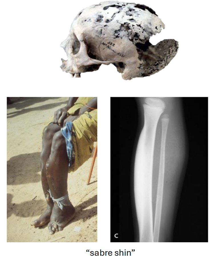 <p>Inflammatory or Infectious Disease Example: Venereal Syphilis</p>
