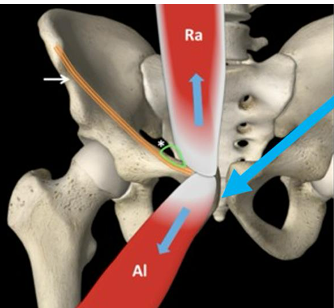 <p><span style="color: red;"><strong>Osteitis Pubis</strong></span></p>
