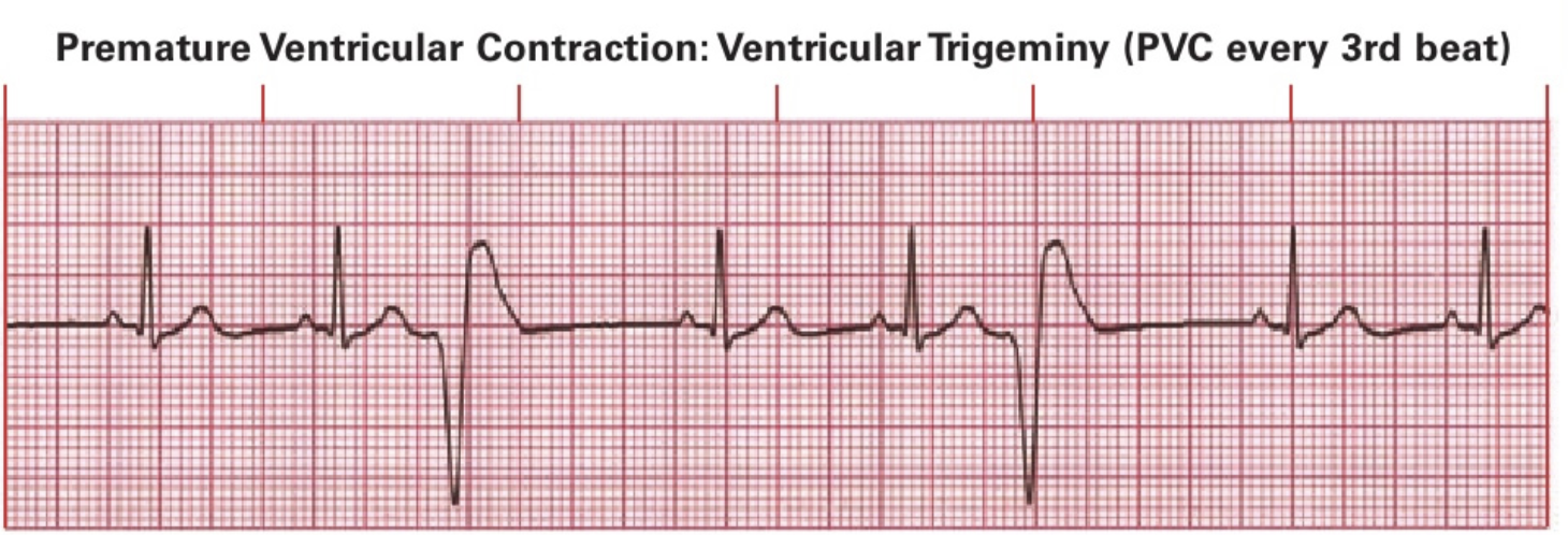<ul><li><p>true</p></li><li><p>need to notify nurse if patient is having a lot; likely will have PVC counter (# in the last minute)</p></li></ul><p></p>