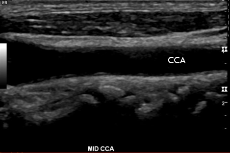 <p>True or False: This image shows a Long CCA sonographic appearance</p>