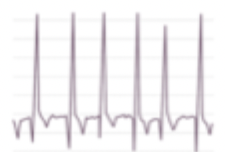 <p>What rhythm is shown?</p>