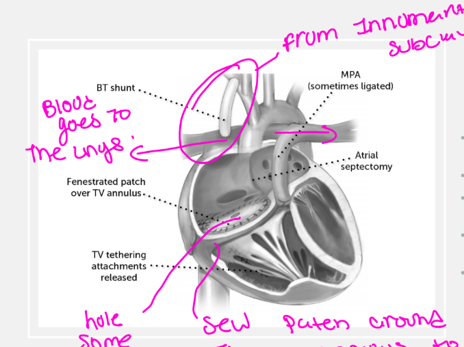 <ul><li><p>Fenestrated patch placed over the true tricuspid annulus</p></li><li><p>Right atrial reduction plasty</p></li><li><p>Atrial septectomy to improve LV preload</p></li><li><p>Main pulmonary artery may be oversewn when severe pulmonary regurgitation is present</p></li><li><p>BT shunt or PDA stent provides pulmonary blood flow</p></li></ul><p></p>