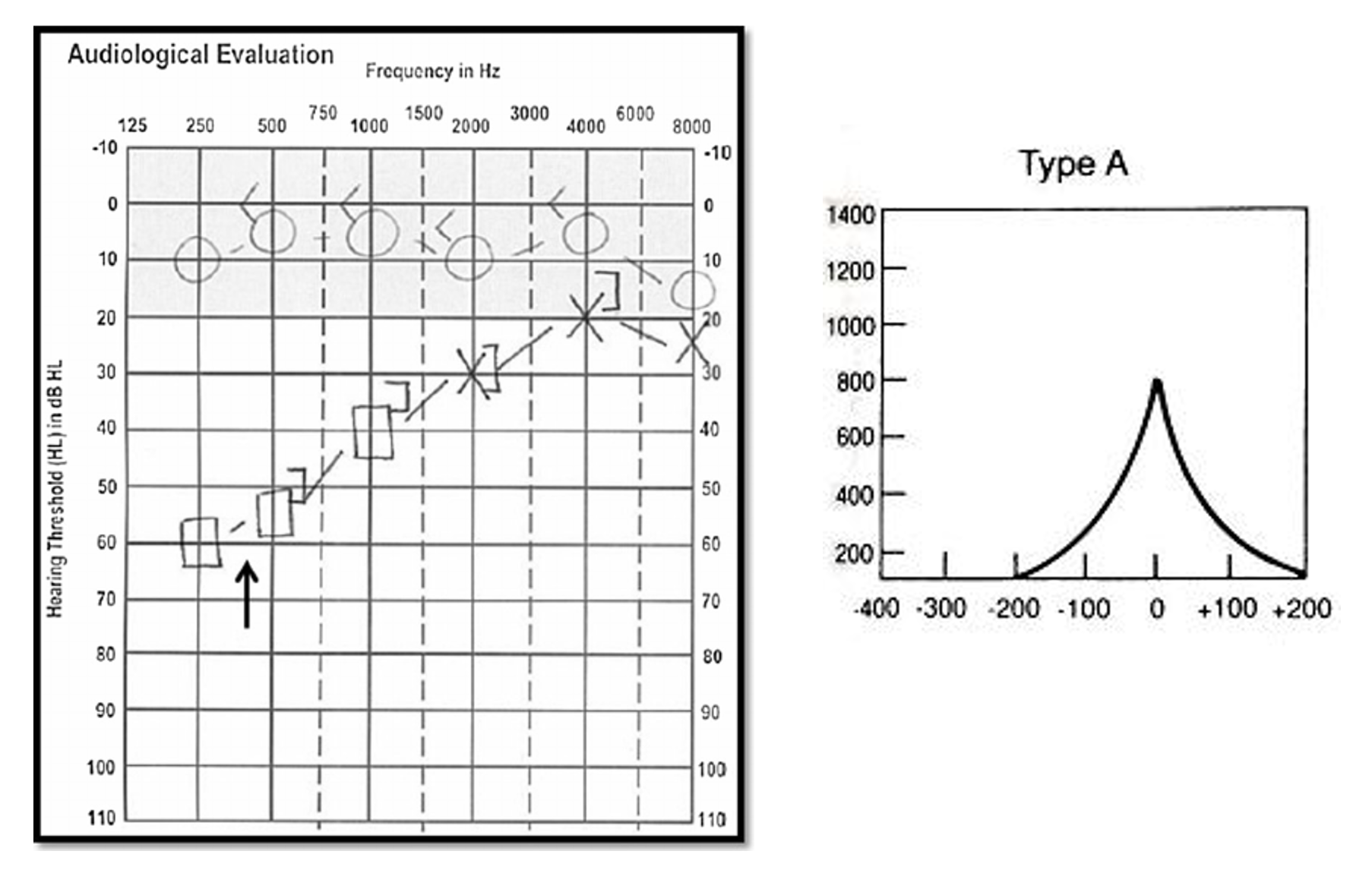 <p style="text-align: left;">Tinnitus (low-pitched)</p><p style="text-align: left;">Severe vertigo</p><p style="text-align: left;">Aural fullness</p><p style="text-align: left;">Hearing loss can fluctuate</p>