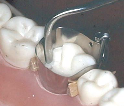<p>What should you do if there is limited tooth structure remaining for support and retention of the retainer?</p>