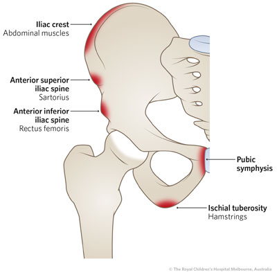 <p>The ASIS is located at the anterior end of the iliac crest and is a key palpable landmark.</p>