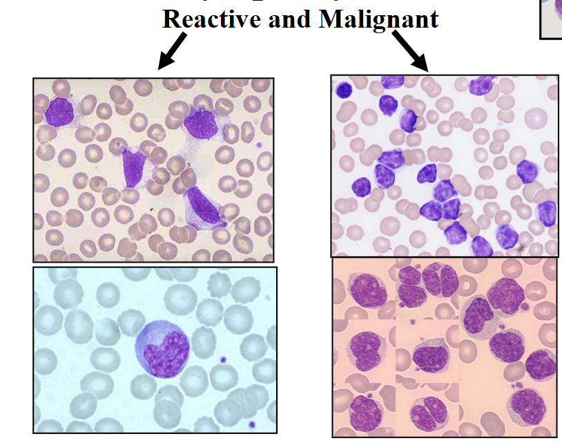 <p>Lymphocytosis (Reactive vs Malignant)</p>