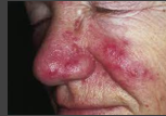 <p>What is this disease?</p>