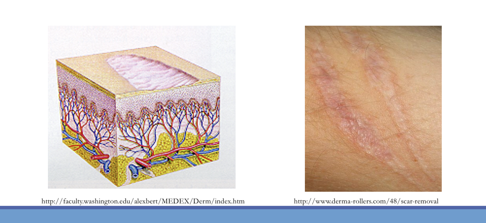 <p>thinning of the dermis or epidermis causing depression in the skin </p>