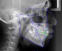 <p>What skeletal measurement:</p><p>- Distance between A point and B point measured along the occlusal plane</p><p>- AP relationship between the maxilla and the mandible</p><p>- Tells you about the AP skeletal classification</p>