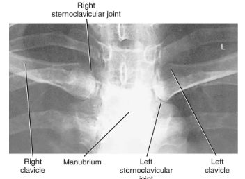 <ul><li><p>Bilateral SC Joints (for comparison)</p></li><li><p>Lateral aspect of manubrium</p></li><li><p>Medial portion of the clavicles visualized lateral to vertebral column through superimposing ribs and lungs</p></li></ul><p></p>