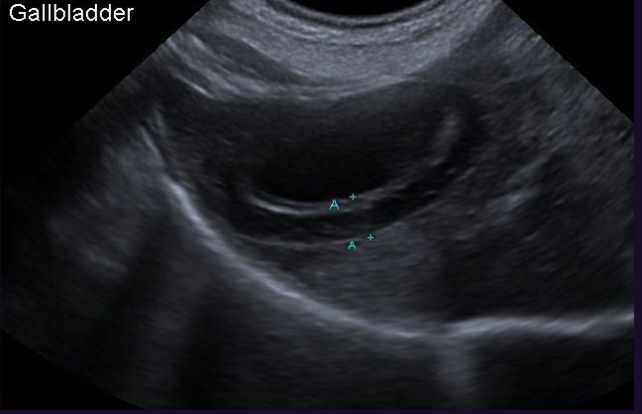 <p>What is shown in this ultrasound and what could it indicate </p>