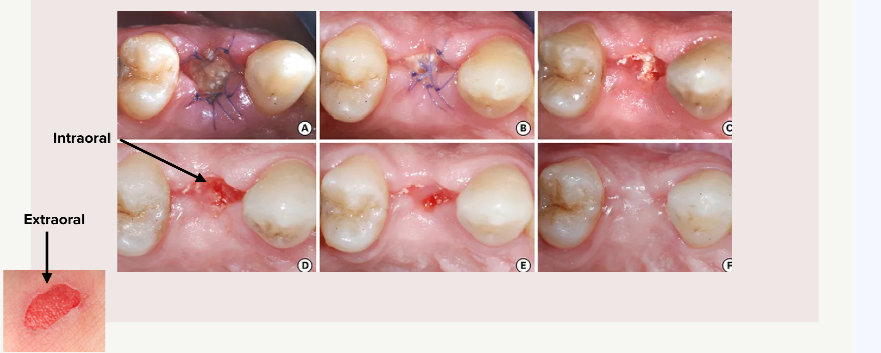 <p>What is <strong>granulation tissue</strong></p>