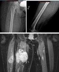 <p>What is this?</p><p>- 15-40 yo</p><p>- No pain</p><p>- ST mass near Knee, hip, ankle jt</p>
