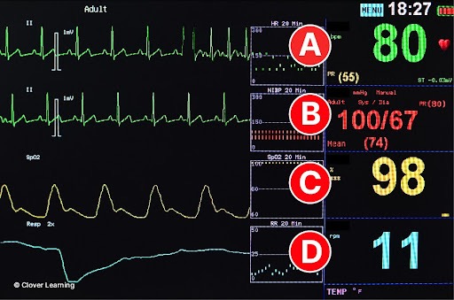 <p>What vital sign is indicated by the letter D on the patient monitor in the image?</p>