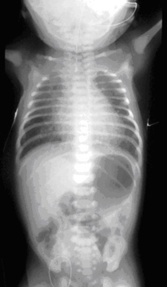 <p>Describe VACTERL?</p><p>-what is the mechanism of this condition?</p>