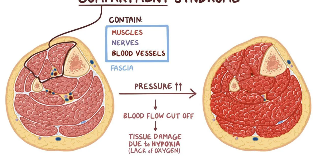 <p><span style="background-color: transparent;">Due to internal hemorrhage, crush injuries, or etiologies causing swelling-like burns</span></p>
