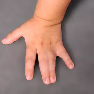 <p>Syndactyly</p>