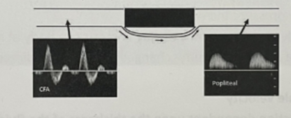 <p>The image shows _____ collateralization.</p><ul><li><p>Complete artery occlusion with very _____ collateralization. Arterioles are maximally _____ BUT _____ is insufficient to maintain flow during _____.</p></li></ul><p></p>