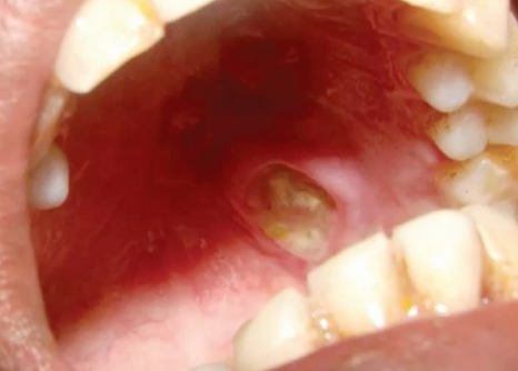 <p>locally destructive inflammatorry condition of salivary gland that can mimic malignancy </p>