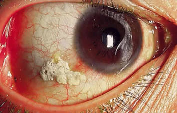 <p>what is this?</p><p>night blindness, dry skin, and bitot spots (pictured)</p>