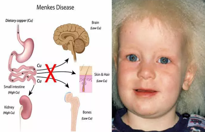 <p>Menkes Disease/copper transport disease/hypercupermia/linky hair syndrome</p>
